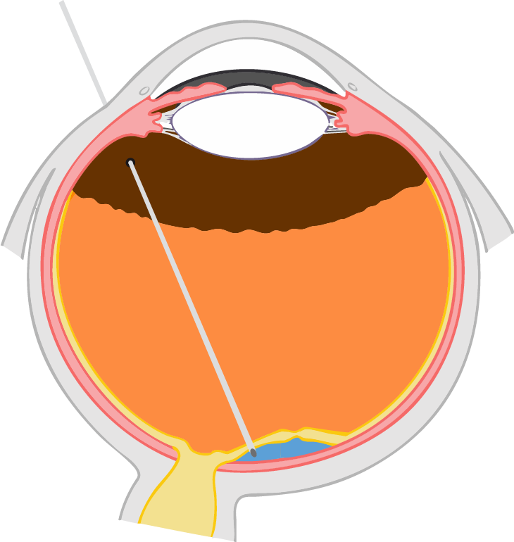 A medical illustration of an eye showing the retina and photoreceptor location for cell therapy treatment.